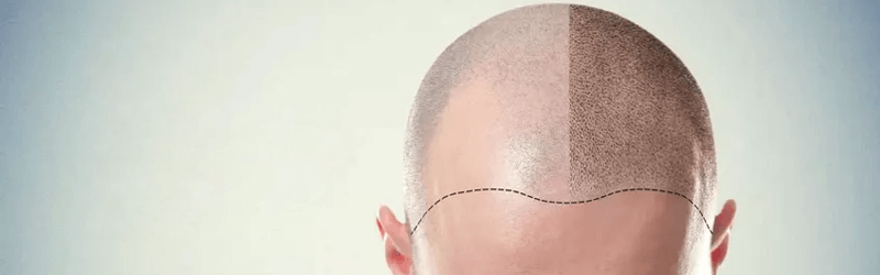 Solve all your queries regarding a hair transplant