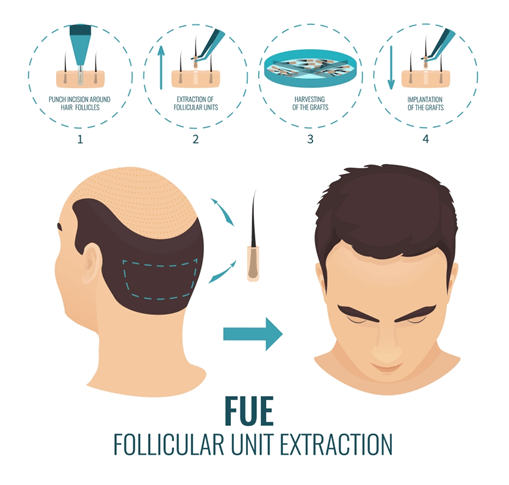 The Dynamics of Follicular Unit Extraction Understanding the Process