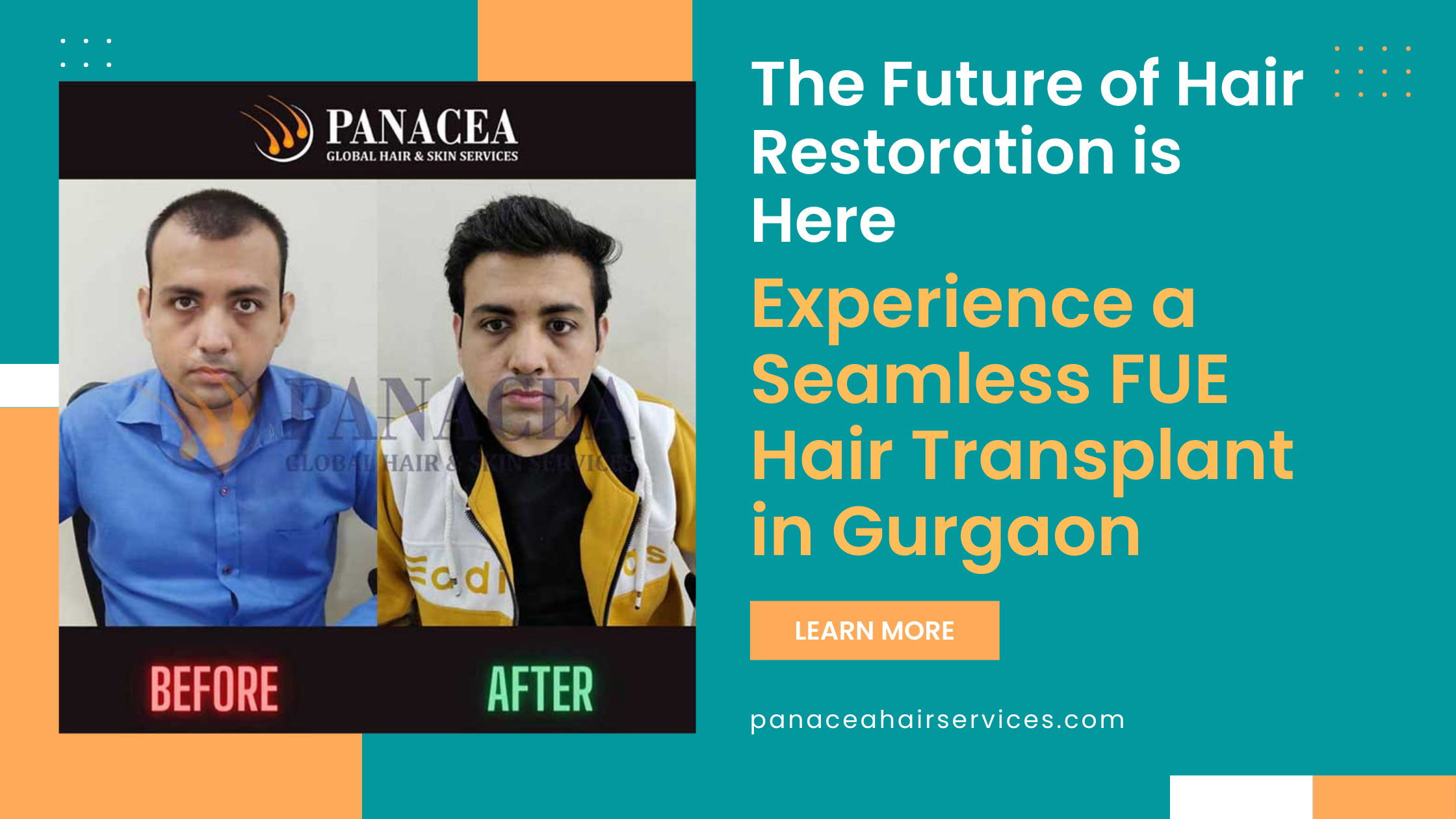 The Future of Hair Restoration is Here Experience a Seamless FUE Hair Transplant in Gurgaon