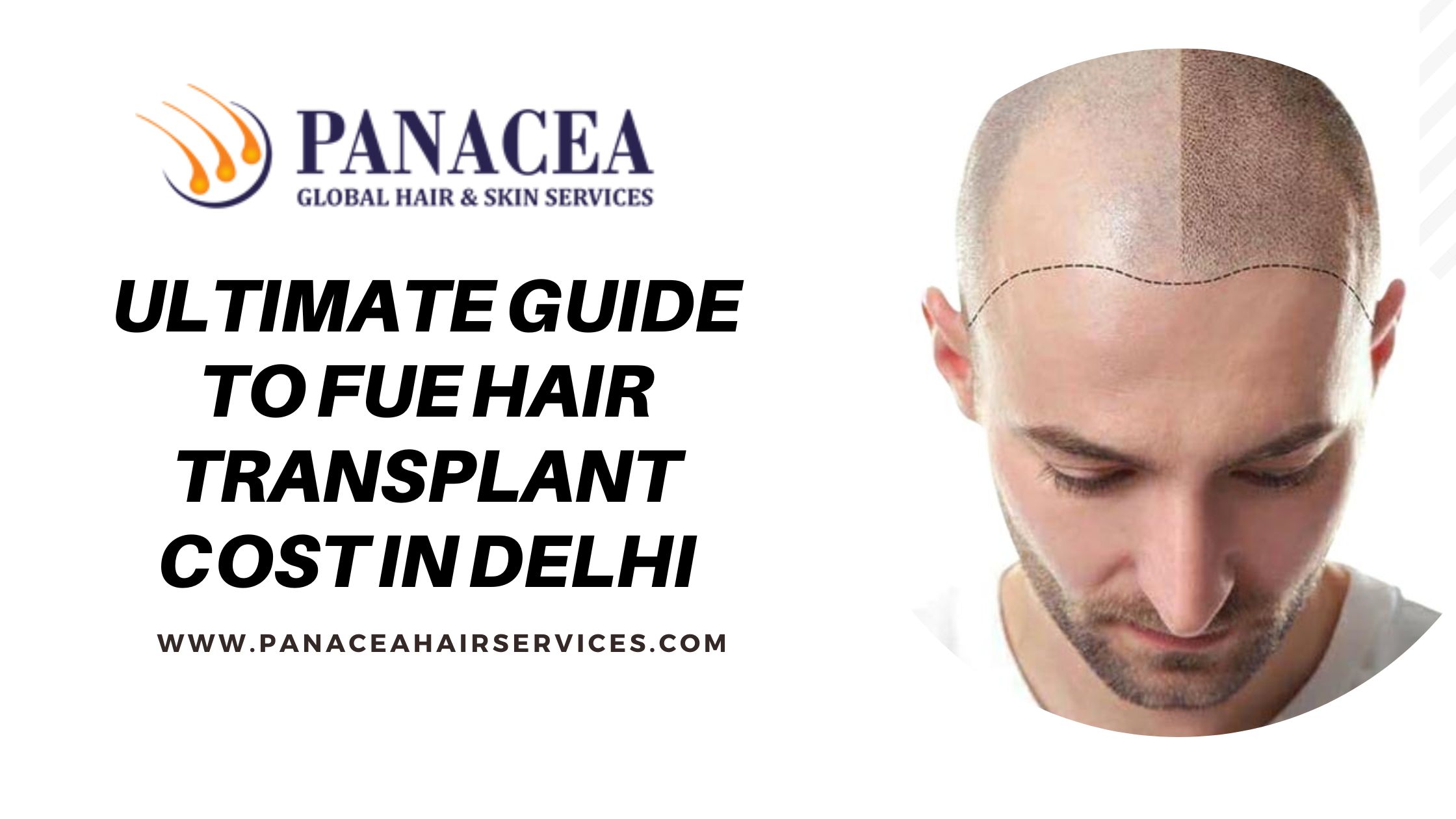 The Ultimate Guide to FUE Hair Transplant Cost in Delhi