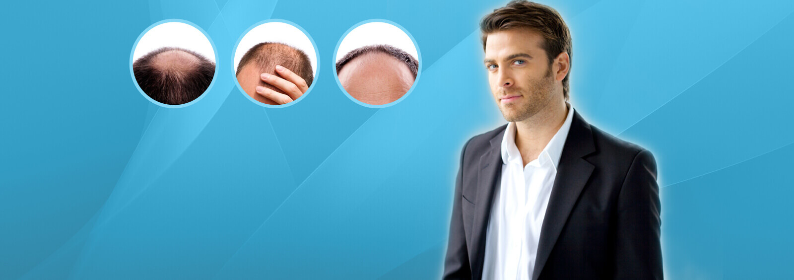 Things To Consider Before Entering into Any Hair Transplant Clinic