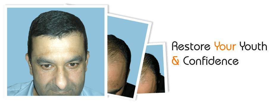 Things to Consider Before Getting A Hair Transplant