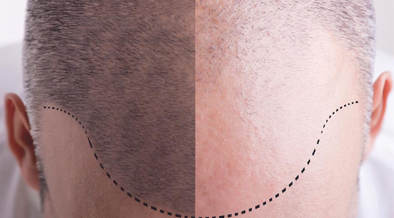 Things to keep in mind for hair transplant