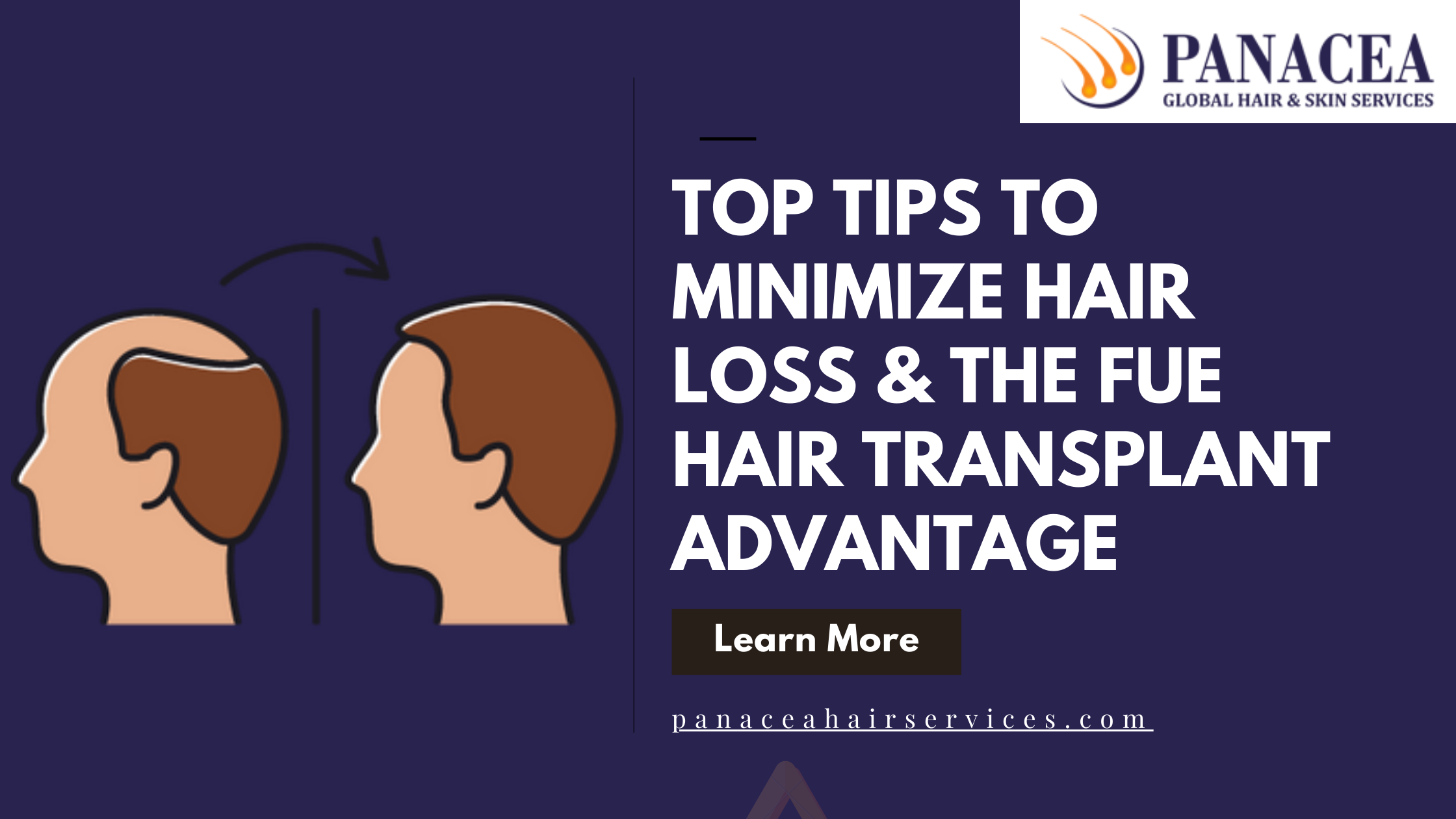 Top Tips to Minimize Hair Loss or the FUE Hair Transplant Advantage