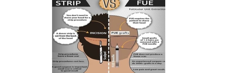 Two stages of hair transplant