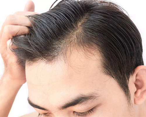 Types Of FUE Hair Transplant