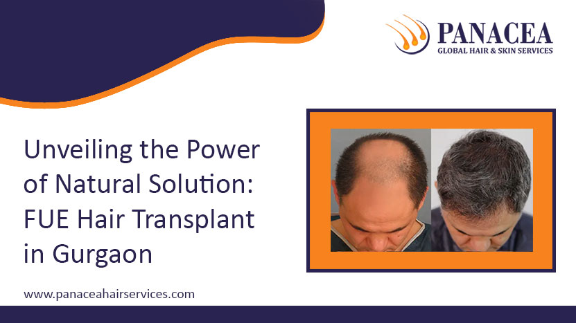 Unveiling the Power of Natural Solution FUE Hair Transplant in Gurgaon