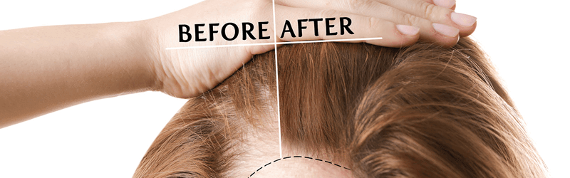 Useful tips before going to finalize a hair transplant