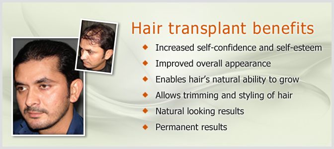 Various Benefits of Hair Transplant Treatment