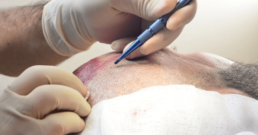 WHAT CAN YOU EXPECT FOLLOWING A HAIR TRANSPLANT PROCEDURE