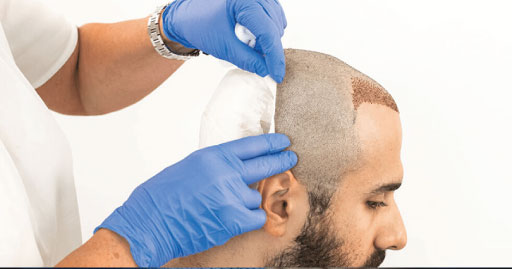 WHAT FACTORS INFLUENCE THE PRICE OF A HAIR TRANSPLANT SURGERY