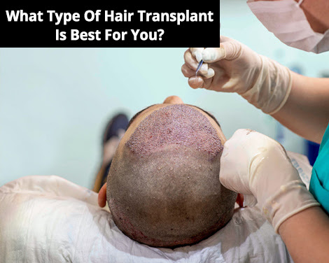 What Type Of Hair Transplant Is Best For You