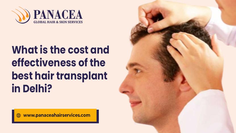 What is the cost and effectiveness of the Best Hair Transplant in Delhi