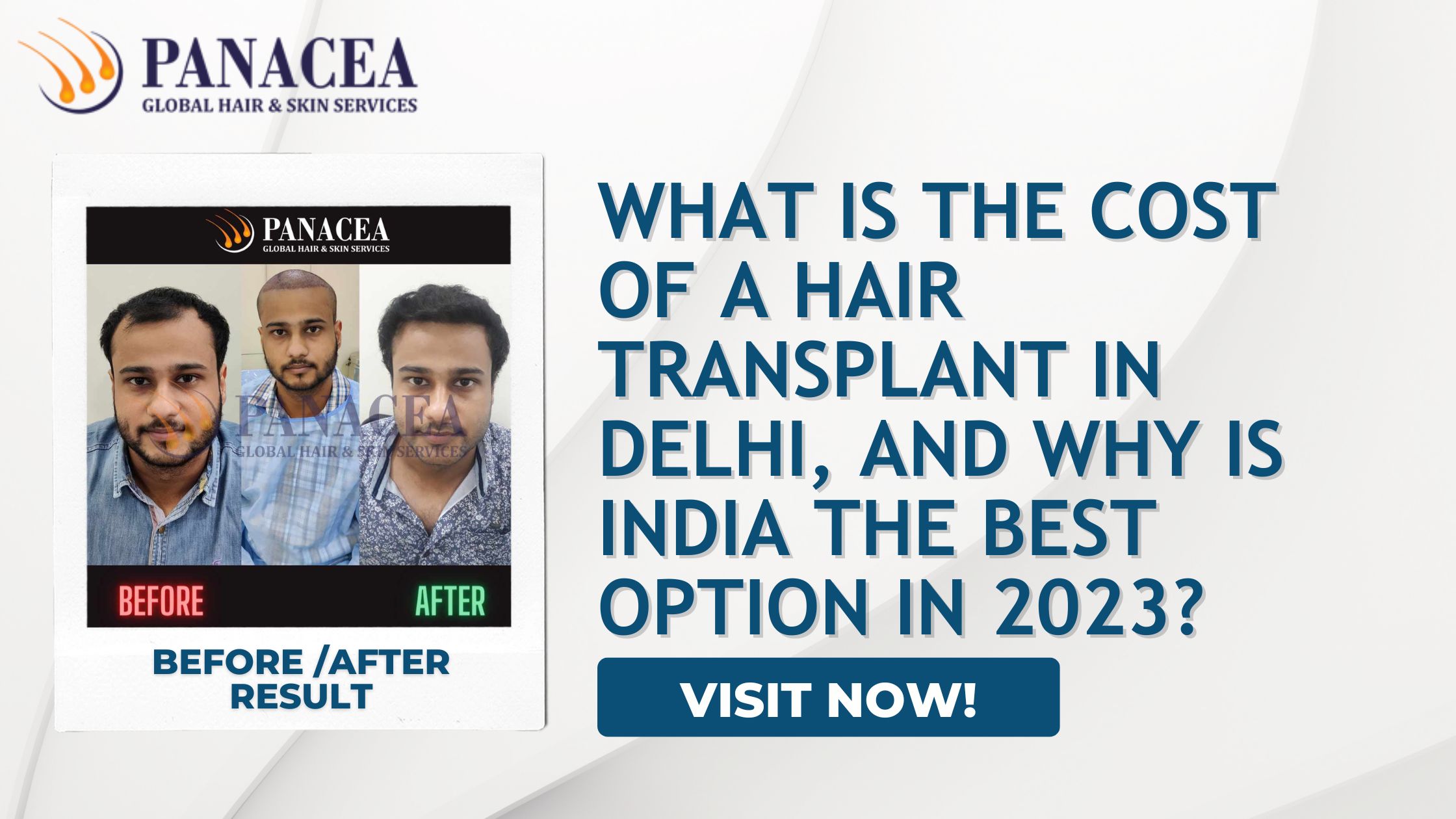 What is the cost of a Hair Transplant in Delhi and Why is India the best Option in 2023