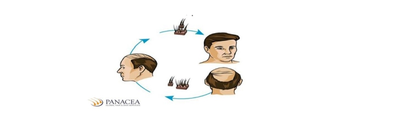 What results to expect out of a hair transplant