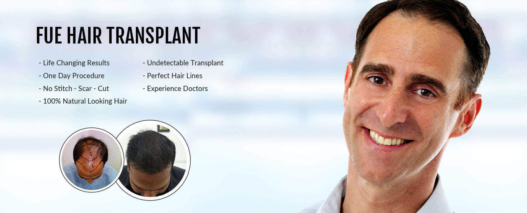 Which FUE Hair Transplant Clinic in Delhi Can Give Full Coverage