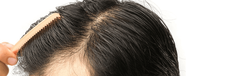 Why a hair transplant