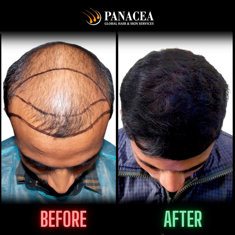 YOUR HAIR LOSS IS TEMPORARY OR PERMANENT