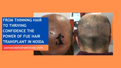 From Thinning Hair to Thriving Confidence The Power of FUE Hair Transplant in Noida