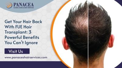 Get Your Hair Back with FUE Hair Transplant 3 Powerful Benefits You Cant Ignore