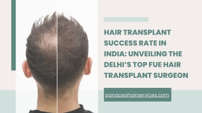 Hair Transplant Success Rate in India Unveiling the Delhis Top FUE Hair Transplant Surgeon