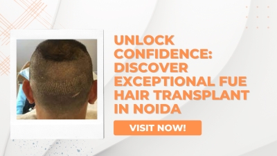 Unlock Confidence Discover Exceptional FUE Hair Transplant in Noida