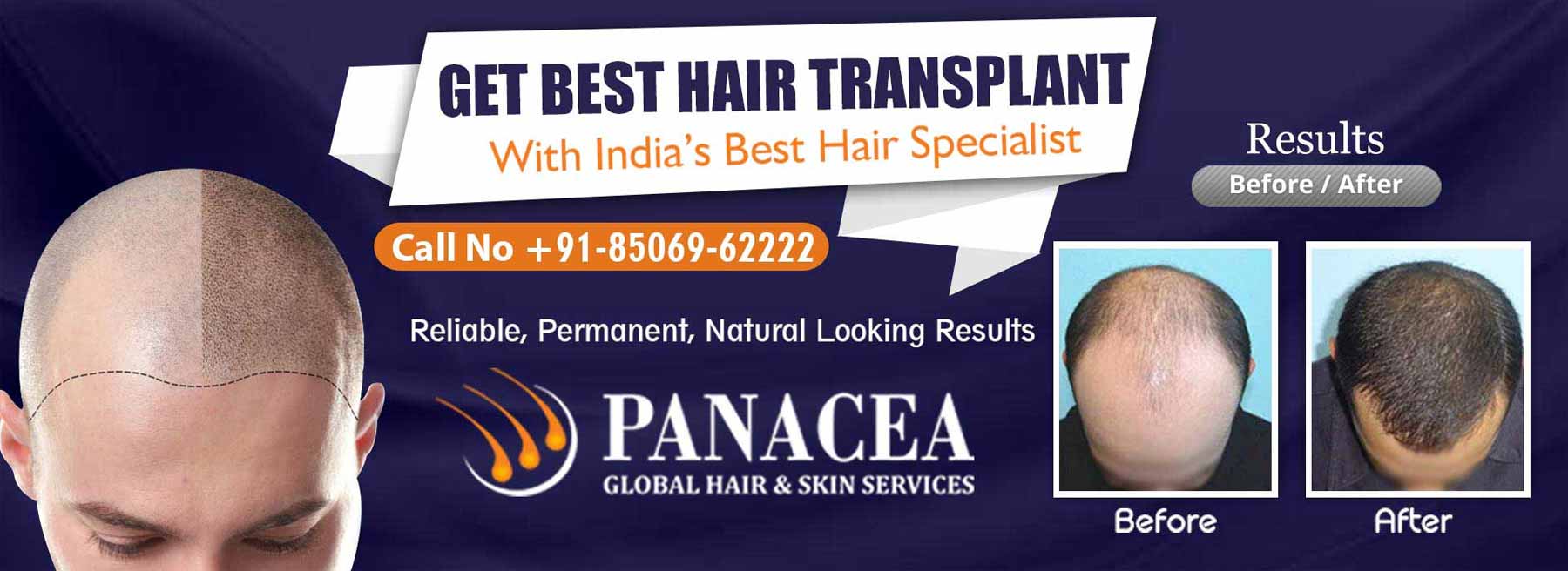 Get Best Hair Transplant - Panacea Global in Mansarover Garden