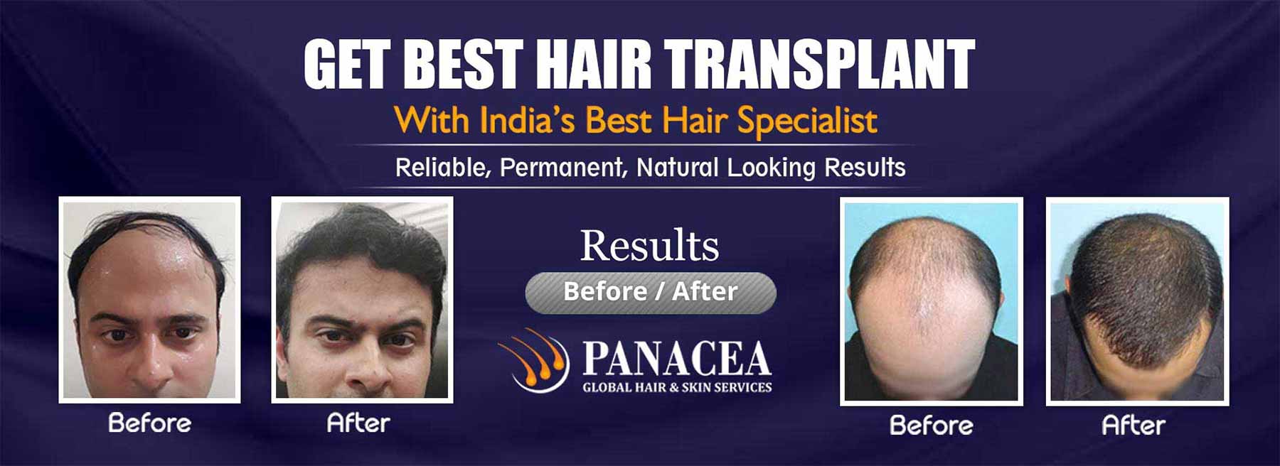 Hair Transplant Before and After Result- Panacea Global in Delhi