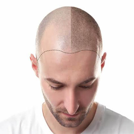 Hair Transplant Repair in Seemapuri