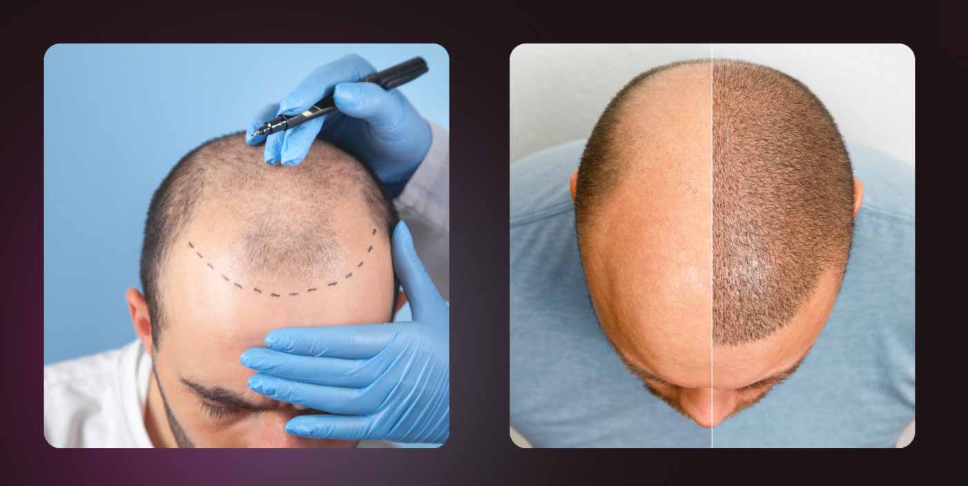 FUE HAIR TRANSPLANT - BEFORE & AFTER RESULTS