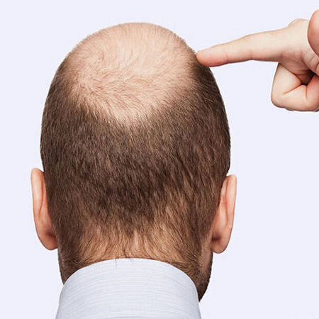 Hair Transplant Clinic in Pul Pahladpur