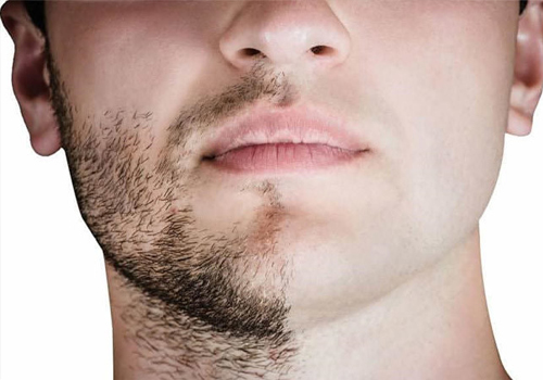Beard Hair Transplant Holding Solution