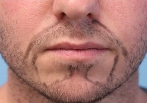 Beard Hair Transplant Before Surgery