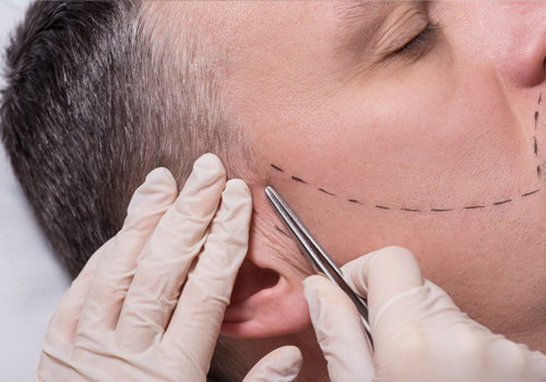 Beard Hair Transplant Procedure