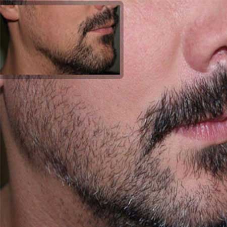 Beard Hair Transplant in Delhi