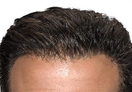 Benefits offered by BIO FUE Hair Transplant Surgery