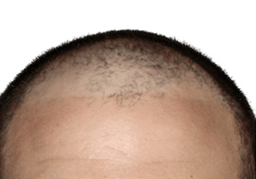 Precautions to Take Before the Surgery To Avoid Bio FUE Hair Transplant Side Effects