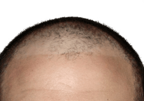 Bio FUE Hair Transplant before Surgery