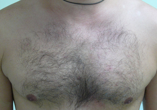 What is the cost of a Body Hair Transplant?