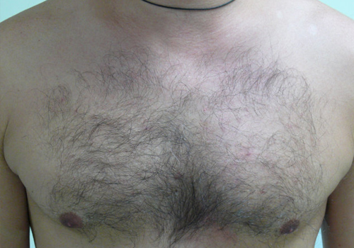 BODY HAIR TRANSPLANT COST