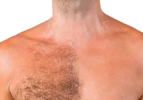 What is a Graft/Hair Follicle?