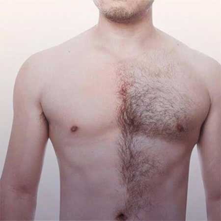 Body Hair Transplant in Delhi