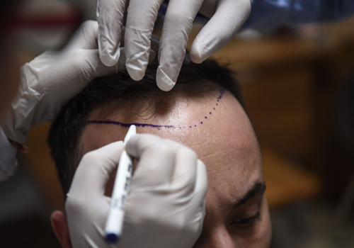 COMPELLING REASONS TO CHOOSE OUR HAIR TRANSPLANT DOCTORS/ SURGEONS