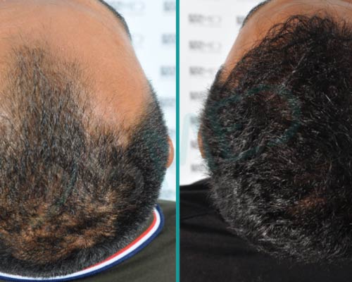 Self-Care Post-Fue Hair Transplant Surgery in Gurgaon