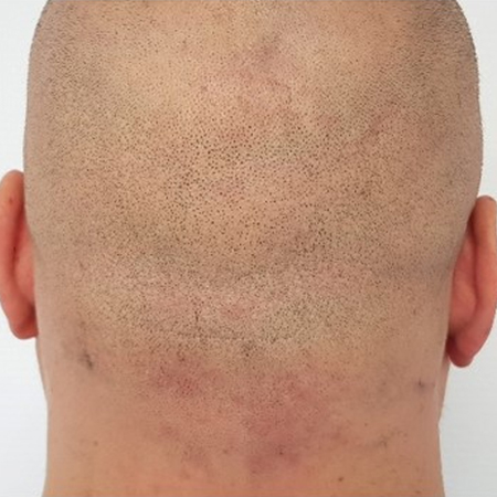 FUE Hair Transplant before Surgery?