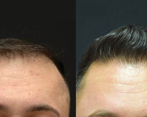 FUE HAIR TRANSPLANT - BEFORE & AFTER RESULTS