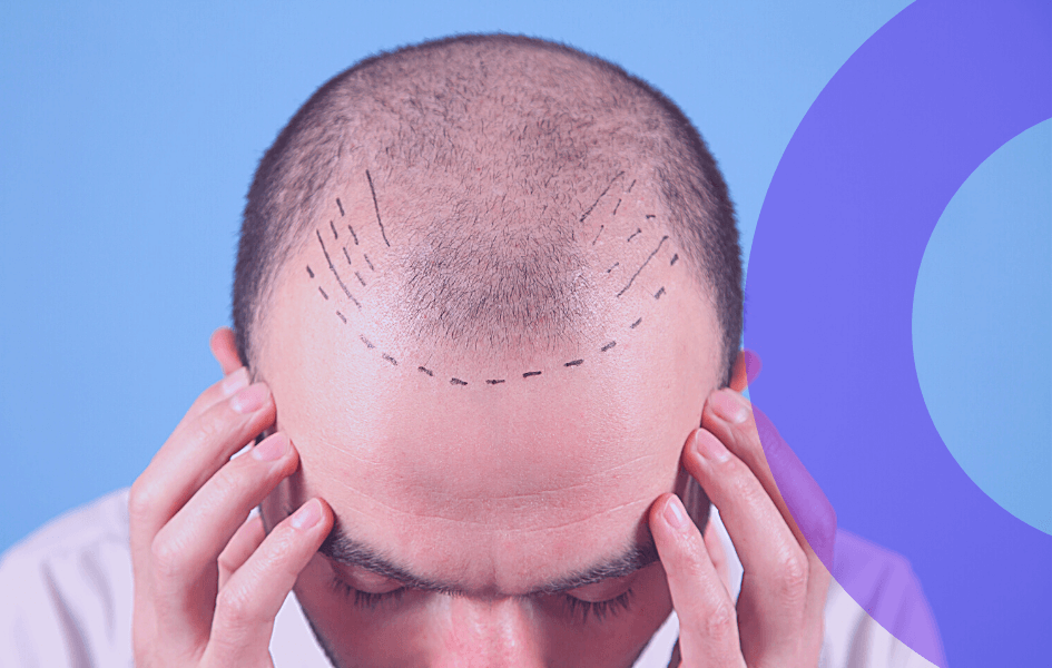 Hair Transplant before Surgery 