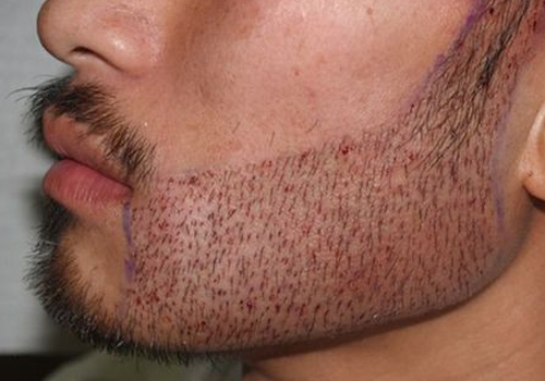 HOW MANY GRAFTS DO YOU NEED?
