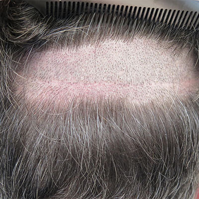 Hair transplant donor area as per top 5 hair transplant surgeon in Mandoli