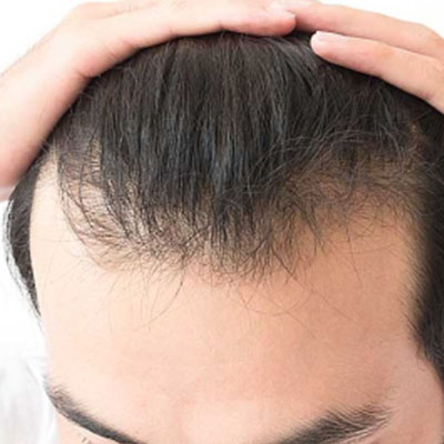 FUE Hair Transplant Holding Solution